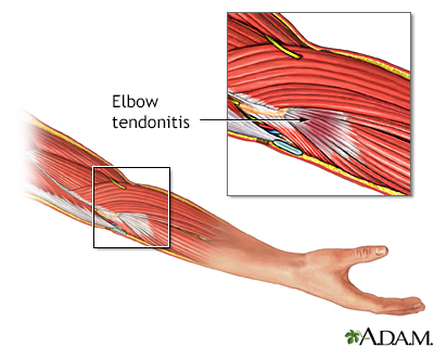 Tendonitis