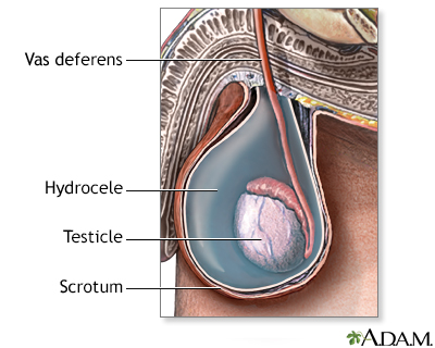 Hydrocele