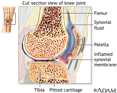 Rheumatoid arthritis