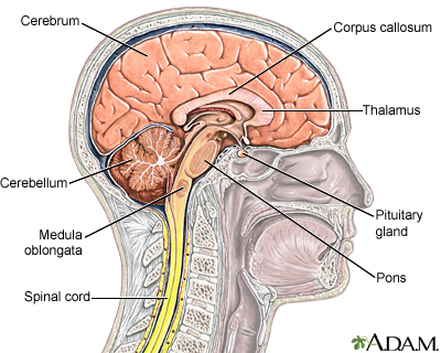 Aseptic necrosis