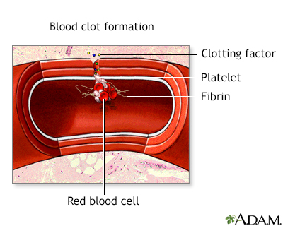 Absent pulmonary valve