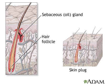 Atrioventricular canal (endocardial cushion defect)