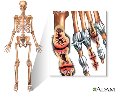 Eisenmenger syndrome (or complex)