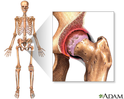 Bicuspid aortic valve