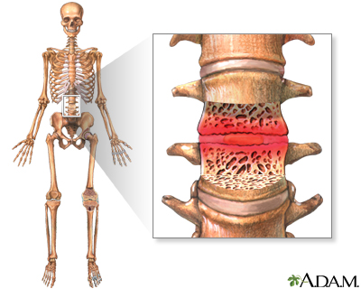 Myocarditis