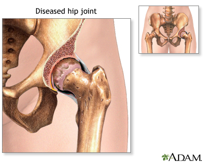 Indications - Torn rotator cuff