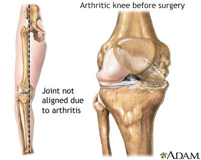 Internal rotation with band