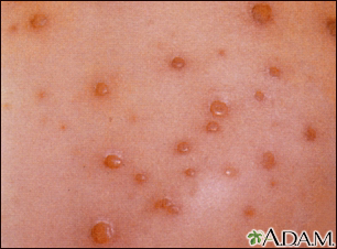 Chickenpox - close-up