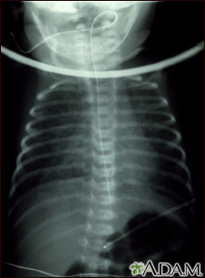 Totally anomalous pulmonary venous return - X-ray