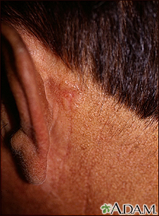 Skin cancer, basal cell carcinoma - behind ear