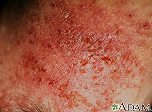 Dermatitis de contacto alérgica - vista de cerca