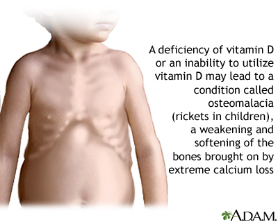 Vitamin D deficit