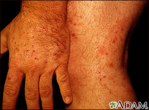 Ringworm - tinea on the hand and leg