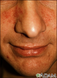 Rosacea