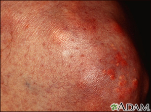 Xanthoma on the knee