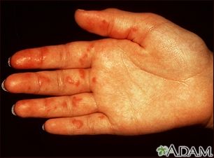 Vasculitis on the palm