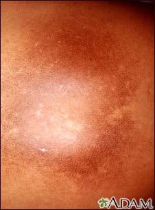 Post-inflammatory hyperpigmentation 2