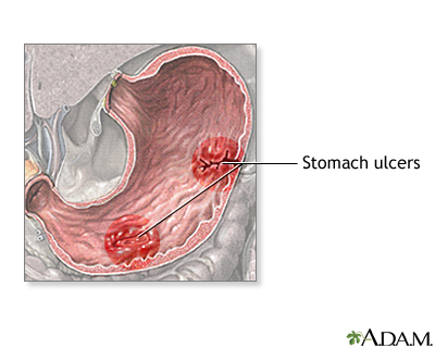 Chronic stomach problems