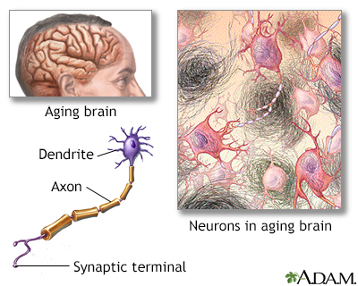 Alzheimer disease