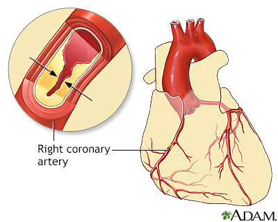 Coronary artery disease