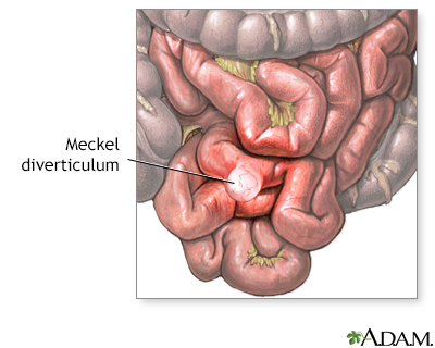 Meckel diverticulum