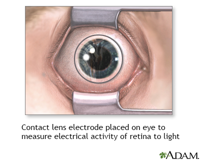 Contact lens electrode on eye