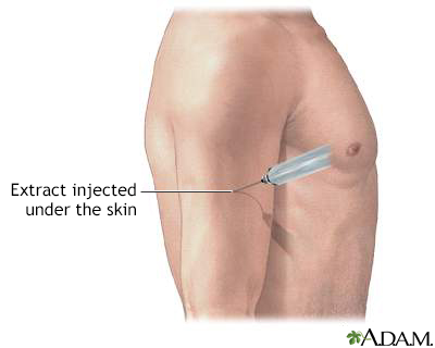 Antigen injection