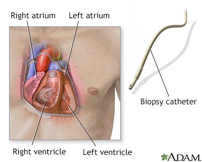 Biopsy catheter