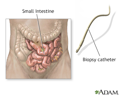 Small intestine biopsy