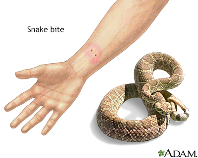 Snake bite