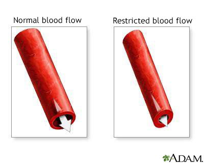 Vasoconstriction