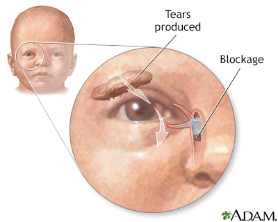 Blocked tear duct