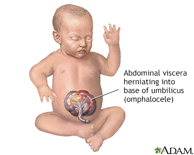 Infant omphalocele