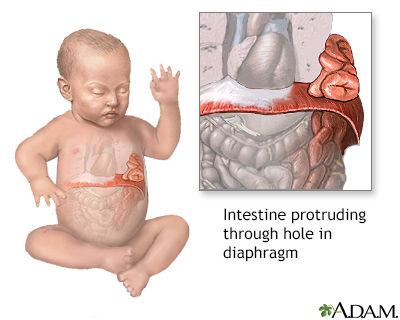 Infant diaphragmatic hernia