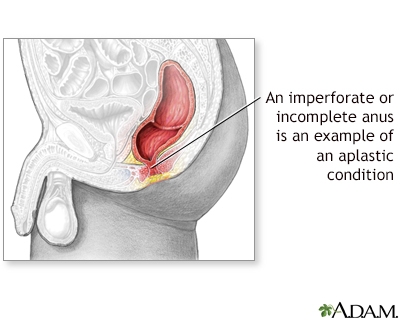 Aplastic condition