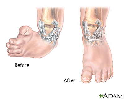 Clubfoot deformity