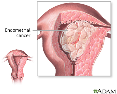 Endometrial cancer