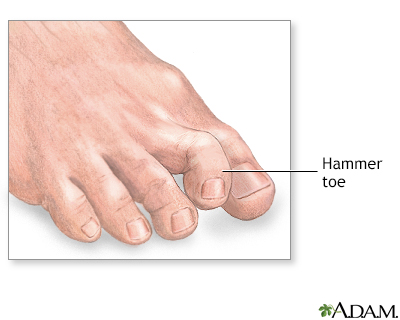 Hammer toe