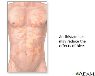 Hives treatment