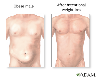 Male with obesity