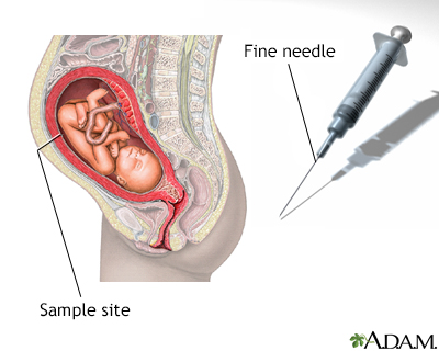 Amniocentesis