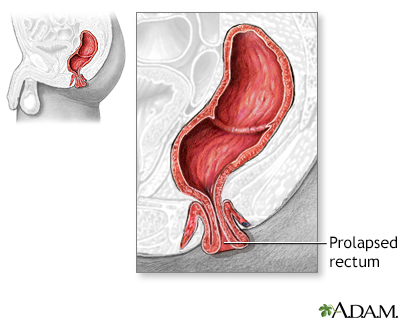 Rectal prolapse