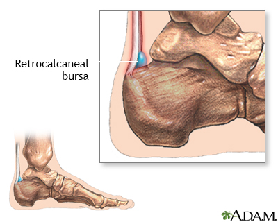 Retrocalcaneal bursitis