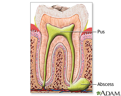 Tooth abscess