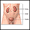 Kidney removal (nephrectomy) - series