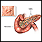 Pancreas transplant - series