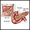 Pancreatitis - series