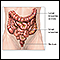 Colon cancer - Series