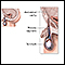 Hydrocele repair - series