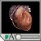 Tachycardia